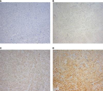 Clinicopathological features and prognosis of TFE3-positive renal cell carcinoma